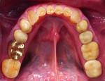 Fig. 4: Pretreatment mandibular occlusal view.