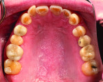 Fig. 5: Pretreatment maxillary occlusal view.