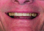 Fig. 6: Direct composite restorations placed at the initial appointment to establish the ideal length of the maxillary central incisors.