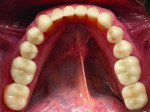 Fig. 10: Occlusal view of the final mandibular restoration.