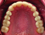 Fig. 11: Occlusal view of the final maxillary restoration.