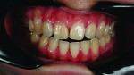 Fig 2. Intraoral examination revealed an anterior open bite with teeth Nos. 8 and 9 tilted mesially, which further affected the smile and brought
attention to the black triangle. Tooth No. 8 appeared discolored.