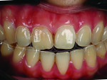 Fig 3. Using digital smile design, the clinician determined the ideal position of
the incisal edges of the maxillary incisors based on facial esthetics. This information was then used to communicate the treatment goals to the
patient.