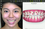 Fig 4. The software interface incorporated a smile design framework into the patient’s smile photograph alongside a ClinCheck image.
The smile design framework assists the clinician in determining such factors as the midline, smile curve, and size and shape of the restorations.
The technician can design attachments to facilitate tooth movement and guide the teeth toward the desired treatment goals.