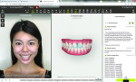 Fig 5. The clinician
opted for two veneers on teeth Nos. 8 and 9. The software generated a virtual representation of the treatment outcome (in-face visualization),
which was valuable in communicating with the patient and inspiring her to proceed with the treatment.