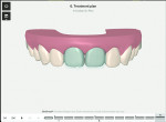 Fig 6. Utilizing 3D controls, the clinician
was able to manipulate the position of teeth Nos. 8 and 9 within the prosthetic envelope (the planned veneer area). The clinician intends to align
the gingival margins of both teeth. Additionally, the incisal edge of the central incisors will be set 1 mm shorter than the veneers, minimizing the
need for incisal reduction and eliminating the need for crown lengthening.