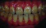 Fig 7. Post–orthodontic treatment, after 14 sets of aligners. Tooth
alignment was well in accordance with the ClinCheck plan. The angulation of teeth Nos. 8 and 9 was corrected.