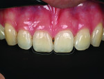 Fig 8. Two larger veneers were
planned as part of the smile restoration. The clinician can export the STL file from the software for the mock-up and tooth preparation.