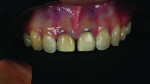 Fig 9. Veneer preparation for teeth Nos. 8 and 9 with minimal reduction and a 0.3-mm chamfer. The interproximal area needed to be opened to
provide space for the ceramist to address the black triangle. Tooth No. 8 was darker than No. 9, but the clinician did not prepare it deeper so that
the ceramist could mask the dark color.