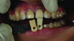 Fig 12. A “dummy” shade was taken using a shade tab made of natural die material. Tooth No. 8 is shade
ND2, and tooth No. 9 is shade ND1. There was an obvious shade difference between the two central incisors