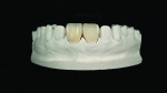 Fig 13. The ultra-thin lithium-disilicate
veneers were fabricated by the ceramist.