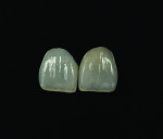 Fig 14. Veneer No. 9 was intentionally made slightly darker than No. 8 to compensate for the color
difference between the two central incisors. This approach was taken instead of using opaque porcelain to mask the darker shade of No. 8.