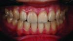 Fig 15. Retracted view 3 months after cementation of the veneers. By this time the veneers had naturally harmonized with the adjacent teeth.