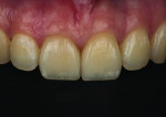 Fig 16. Photograph of the veneers 3 months post-treatment with black background, showcasing the ideal shade-matching of Nos. 8 and 9 and
the excellent craftsmanship of the ceramist.