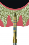 Fig 2. A pilot drill is taken to 1 mm below the sinus floor at the molar’s septum.