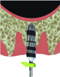 Fig 3. Osseodensifying burs are
used in a clockwise direction at 800 to 1,200 rotations per minute, to reach 1 mm below the sinus floor.