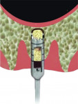 Fig 4. A trephine is utilized to 1 mm
below the sinus floor.