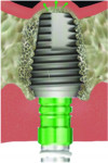 Fig 6. The implant is placed, further elevating the sinus floor.