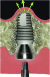 Fig 7. Bone–graft–implant core imploding. (Fig 2 through Fig 7 were provided by Dr. Gracia.)