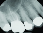 Fig 8. Teeth Nos. 2 and 3 were hopeless due to
periodontal bone loss between them.