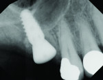 Fig 9. Modified localized management of sinus floor technique in fresh molar socket at the first molar
and socket preservation at the second molar site.