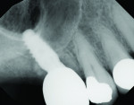 Fig 10. Restoration completed on the implant that was placed with a crestal sinus elevation,
5 months post–implant placement.