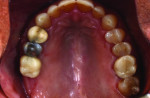 Fig 11. Clinical occlusal view of the restored implant at the first molar site treated with a crestal sinus elevation
at implant placement, 5 months post–implant placement.