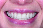 Fig 2. Preoperative close-up smile.