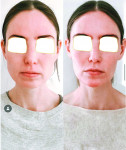 Fig 4. Note the
change in masseter muscle size before (left) and after (after) Botox treatments.