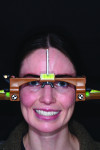 Fig 8. Full-face view of the patient with facial reference glasses in place. This photograph would be part of a series used to help create a
digital dentofacial analysis.