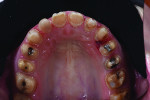 Fig 9. Maxillary arch after removal of crowns.