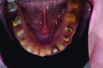 Fig 11. Mandibular arch after removal of crowns.