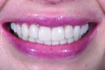 Fig 13. Close-up view of the patient’s smile with the provisional restorations in place.