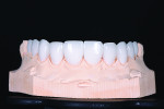 Fig 14. Maxillary porcelain restorations on model.