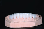 Fig 15. Mandibular porcelain restorations on model.