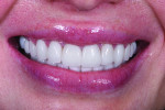 Fig 16. Close-up view of the patient’s
smile with the final restorations in place at 1-month follow up.