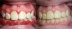 Fig 6. Clinical example of a study patient demonstrating elimination of gingival inflammation utilizing twice-daily rinsing with the chlorine dioxide rinse after 5 weeks.