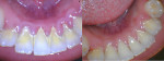 Fig 7. Clinical example of a study patient who presented routinely at recall appointments with calculus on the mandibular anterior lingual surfaces of the teeth (left) and at recall at 3 months with elimination of gingival inflammation and an absence of calculus (right) utilizing the chlorine dioxide rinse twice daily between recall appointments.