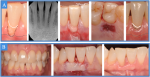 Fig 3. Overview of clinical cases referred to a periodontist in private practice for the correction of mucogingival deformities. After discussing options with both patients, they opted for autogenous grafting to correct the lack of keratinized tissue (A, B) and recession coverage (A). One can evaluate the clinical outcomes and success of both procedures.