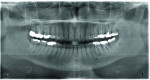 (1.) Preoperative panoramic radiograph showing a periapical radiolucency associated with tooth No. 18, which had previously undergone root canal treatment.