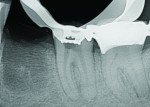 (3.) Radiograph demonstrating the conservative removal of the gutta-percha.