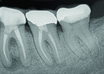 (2.) Preoperative radiograph showing the periapical radiolucency associated with tooth No. 18.