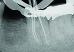 (6.) Cone fitting procedure following completion of the GentleWave Procedure demonstrating the minimally tapered re-preparation.