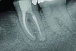 (7.) Immediate postoperative radiograph following obturation and immediate coronal seal.