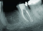 (8.) One-month postoperative follow-up radiograph.