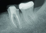 (9.) One month postoperative follow-up radiograph acquired after crown seating.