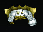 (5.) Planning view of the surgical guide design.