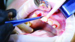 (7.) Extractions being performed using the displacement method.