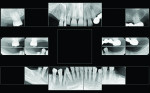 (1.) Preoperative full mouth series of radiographs.