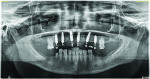 (16.) Postoperative panoramic radiograph confirming full seating of the provisional prosthesis.